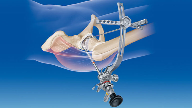 Máxima eficacia en la artroscopia de la cadera