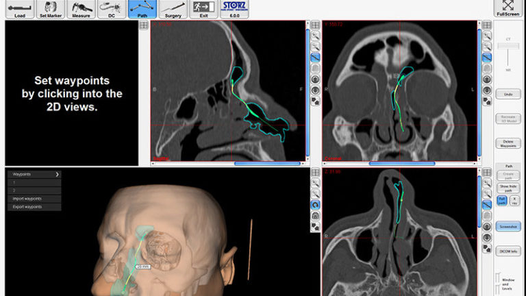 NAV1® SinusTracker™ - Un programa innovador para la planificación de las vías de acceso en la cirugía de los senos paranasales
